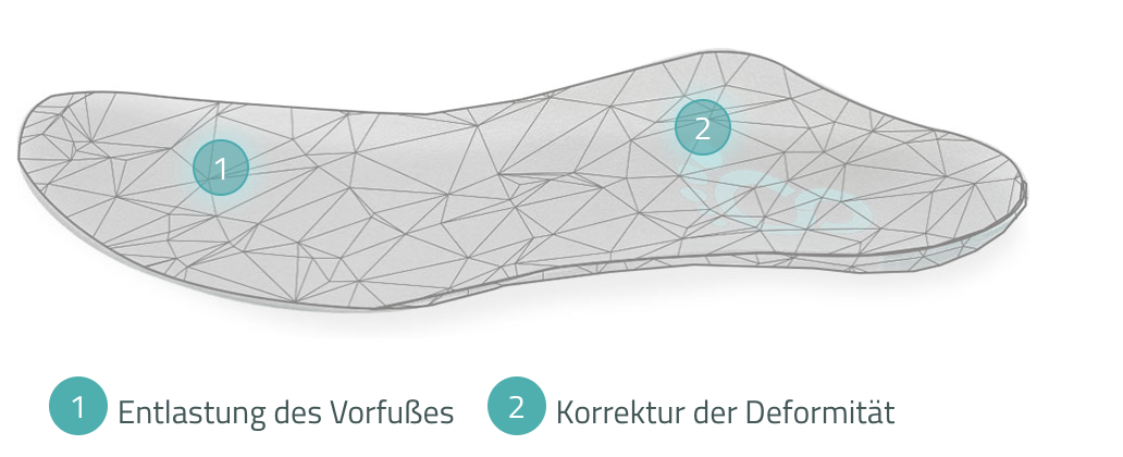 Orthopädische Masseinlage von Cordewener bei Spreizfuss zur Entlastung des Vorfusses
