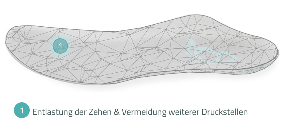 Custom orthopaedic insole by Cordewener for hammer and claw toes, relieving the toes